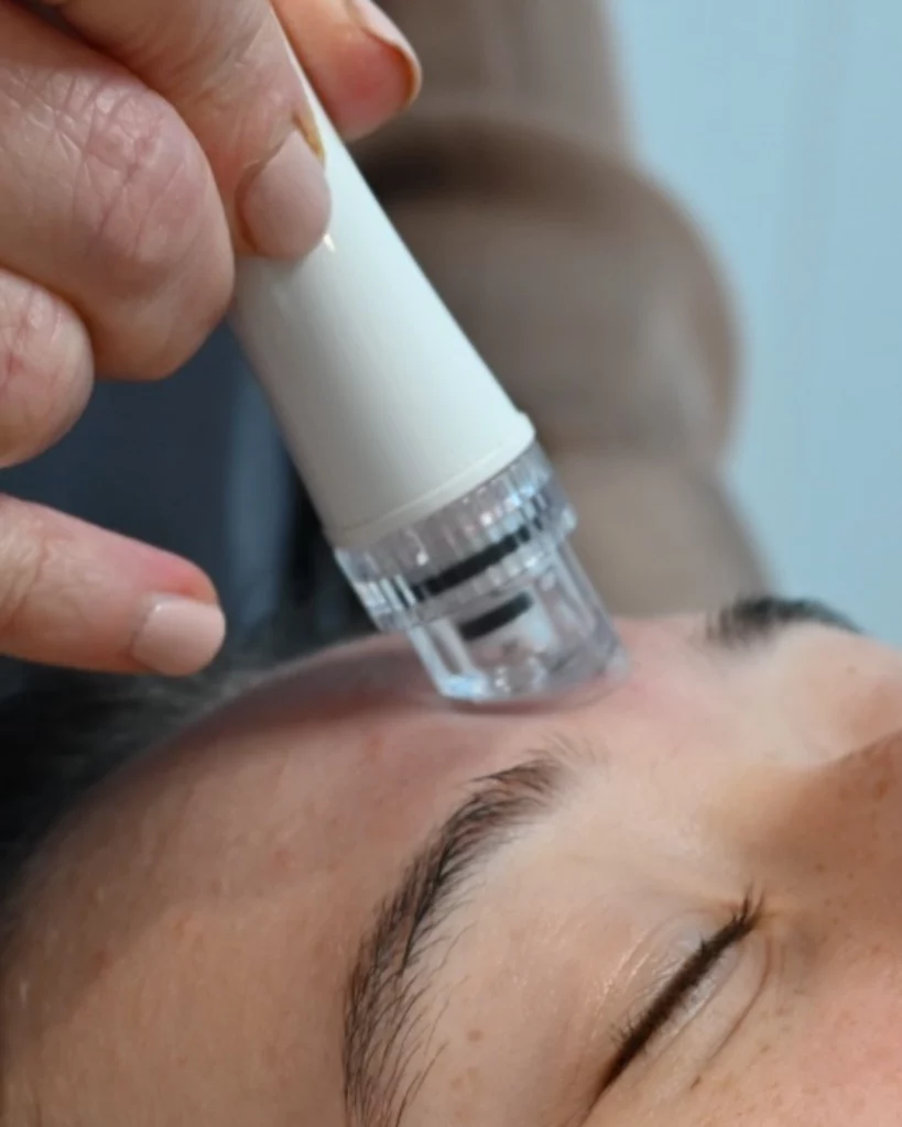 Aqua Micro-dermabrasie behandeling waarbij de aquafacial zachtjes over het gezicht glijdt om de huid te exfoliëren en te hydrateren. Ontdek de voordelen van deze behandeling bij schoonheidssalon Jouw Huid
